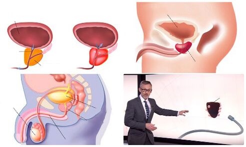 vesela un slima prostata