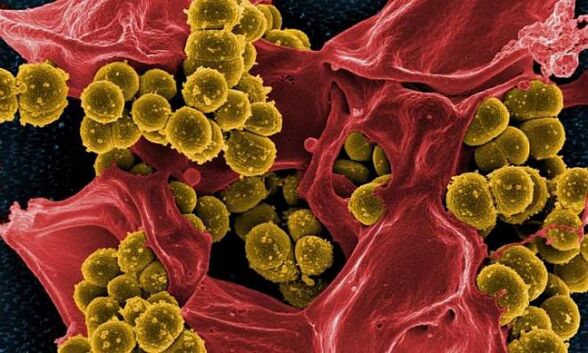 Staphylococcus aureus kā bakteriāla prostatīta cēlonis
